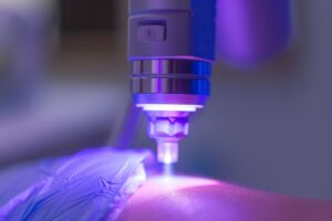 pigmentation-removal-session-with-laser-device-emitting-light-close-up-medical-cosmetic-use (1)